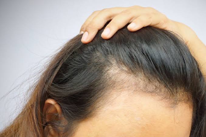PRP Hair Loss Treatment Watford - Javaani Clinic Dr Administered