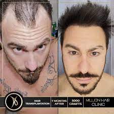 Million Hair Center Sac Ekim Merkezi