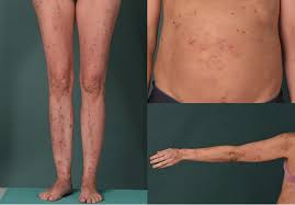 Image result for pruritic urticarial papules and plaques of pregnancy