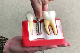 Image result for dental implant