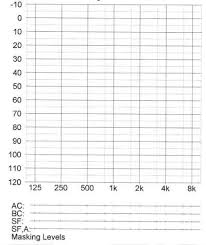 Clinical Junior Com How To Read Audiogram And Tympanogram