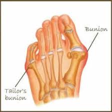 Bunionette Deformity Or Tailor S Bunion Sussex Foot Ankle Clinic