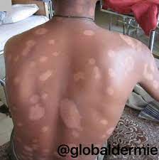 Borderline, or dimorphous, hansen's disease is the most common form. Josette Mcmichael Md Faad On Twitter 23m Borderline Lepromatous Leprosy 5 Types Of Leprosy Tuberculoid Intact Cell Mediated Immunity Lepromatous Poor Immune Response 3 Intermediate Stages Including Bll Lesions Symmetric Numerous Patches