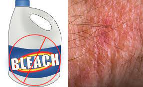 We did not find results for: Bleach On Poison Ivy Poison Oak Poison Sumac Is It Safe