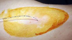 Lerchen geburtshilfliche periduralanästhesie (pda) eine. Periduralanasthesie Pda Zur Schmerzlinderung Wahrend Der Geburt Seite 2 Babywelten Ch