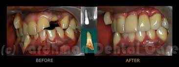 A Dental Implant To Replace A Split Tooth A Post Supported Crown For A Half Broken Tooth Another Crown Fo Dental Implants Mini Dental Implants Broken Tooth