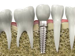 Image result for dental implant