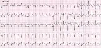 › basic ekg practice test. Ecg Ekg Examples And Quiz Oxford Medical Education