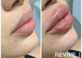 At two weeks, there's generally no swelling. Lip Filler Facts Revive Medical Philadelphia