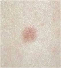 Purpura are purple or red spots on the skin or mucus membranes. Skin Disorders In Older Adults Vascular Lymphatic And Purpuric Dermatitides Part 1