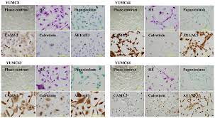 The physiologic regulation of stat1 via socs1 is completely lost in malignant pleural mesothelioma (arzt et al., 2014, 2017). Representative Images Of The Established Malignant Pleural Mesothelioma Download Scientific Diagram