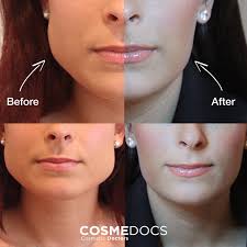 Patients have reported improvements in their tmj pain after botox® treatments. Teeth Grinding Treatment Bruxism Tmj Disorder Jaw Clenching