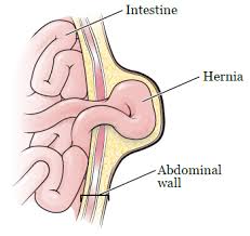 Maybe you would like to learn more about one of these? About Your Abdominal Incisional Hernia Surgery Memorial Sloan Kettering Cancer Center
