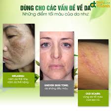 Kem Trị Nám, Loạn Sắc Tố Da