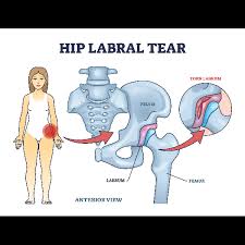Image result for Hip Labral Tear
