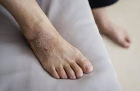 Image result for Pitting nails feet