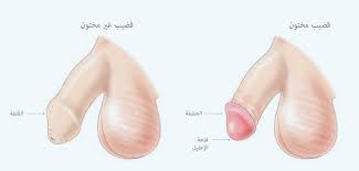 الختان איך גדלת