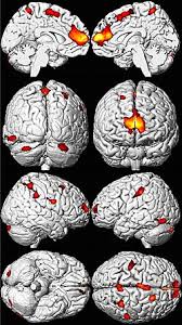 Image result for Brain Lesion