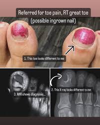 Image result for Glomus tumor