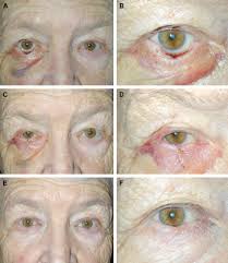 Image result for Eyelid Closure Defect