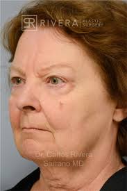 Landing Facelift Ads