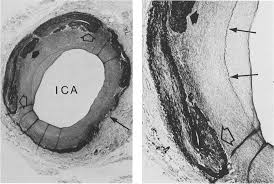 Sequential morphological changes at the site of carotid endarterectomy