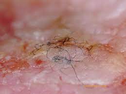 Unexpected psychodermatological problem for parasitologists впервые термин morgellons disease появился в 2002 г. Charles E Holman Morgellons Disease Foundation En Twitter Morgellons Fibers Are Typically Microscopic And Cannot Be Seen With The Naked Eye The Filaments Present Embedded In The Skin In A Manner Which