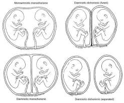 Types Of Twins Chart Twins Ultrasound Faternal Twins