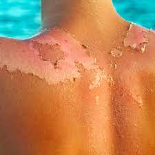 Jul 05, 2019 · unfortunately, there's no way to prevent your skin from peeling, but there are a few ways you can help speed up the process. Sunburn Peeling How To Stop Sunburn Peeling Fast And Safely