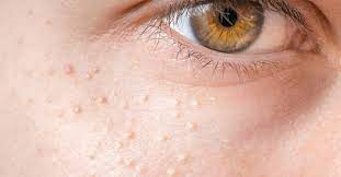 Grey and white hair has no melanin at all. Milia The Little White Spots You Shouldn T Pop Australian Skin Clinics