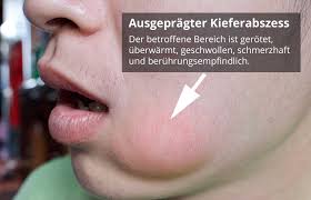 Einige menschen haben größere oberlippen und einige haben größere unterlippen. Kieferabszess Ursachen Symptome Behandlung