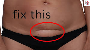Studies show that the rate of cesarean sections in canada continues to rise. How Can I Reduce The Visibility Of A C Section Scar