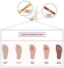 Image result for IDSA Diabetic Foot Wound Classification