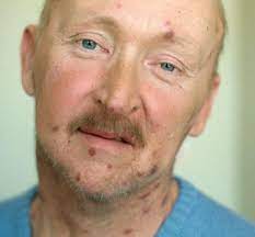 الأعراض المميزة للإيدز لدى الرجال