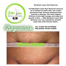 How long does it take to recover from a brazilian laser hair removal? Laser Hair Removal Express Home Facebook