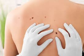 Masz dużo pieprzyków? Zobacz, co to oznacza :: RMF FM