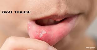 Image result for oral thrush symptoms roof of the mouth