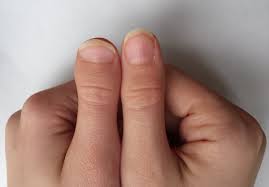 Megan fox's stubby thumbs megan fox was born with a condition called brachydactyly thumbs, which means that her thumbs are slightly clubbed or misshapen. Clubbed Thumb Wikidata