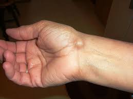 ganglion kist ganglion kisti nedir ganglion nedir el bilegi ustundeki sislik nedir ganglion kist tedavisi nasil olur