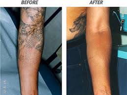 Surgical excision of skin containing tattoo pigment is also conventional but often results in incomplete tattoo removal, tissue distortion, and scarring recently applied tattoos respond better to treatment (particularly during the first month after application) with the carbon dioxide and argon lasers. 9 Best Laser Tattoo Removal Treatments I Fashion Styles