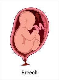 Image result for Breech Presentation