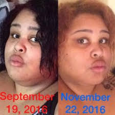 Before and After Duodenal Switch Photos