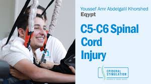C5 C6 Spinal Cord Injury Patient Youssef Talks About His Epidural Stimulation Experience Youtube