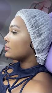 O preenchimento do mento (queixo), é capaz de mudar o perfil de um/uma  paciente, quando combinado ao preenchimento labial e rinomodelação,  chamamos de perfiloplastia., A combinação de um belo nariz, ...