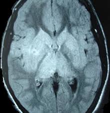 It is usually bilateral but asymmetrical. Mri Features Of Japanese Encephalitis Bmj Case Reports