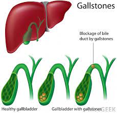 Other cause could be not moving and exercising after the surgery. What Causes Weight Loss After Gallbladder Surgery