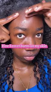 How to Cover A Burn Scar with Makeup