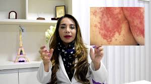 Suar na virilha é totalmente normal. Assadura Youtube