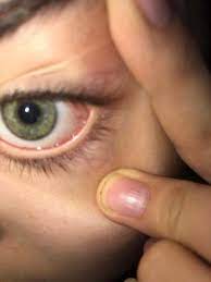 Warum Ist Mein Auge Aufeinmal So Rot Gesundheit Und Medizin Gesundheit Augen