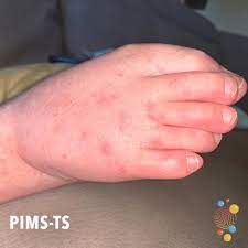 In general, rashes linked to the virus come up suddenly. Pims Ts Skin Deep